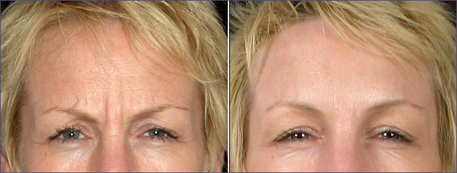 BOTOX® Patient Photo