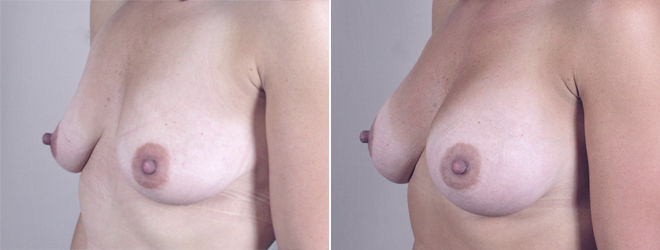 New Jersey Breast Augmentation Image