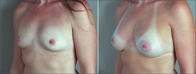 Breast Augmentation New Jersey Image