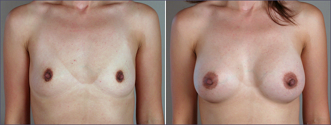 breast augmentation New Jersey image