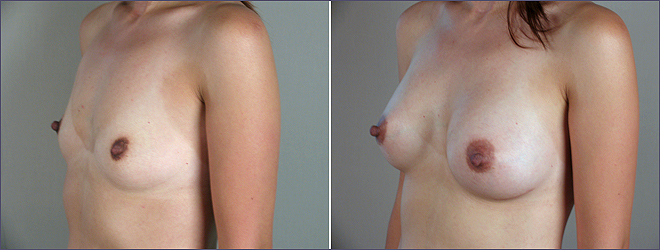 breast aumengation New Jersey image