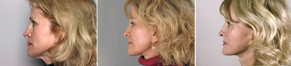 Facelift Image