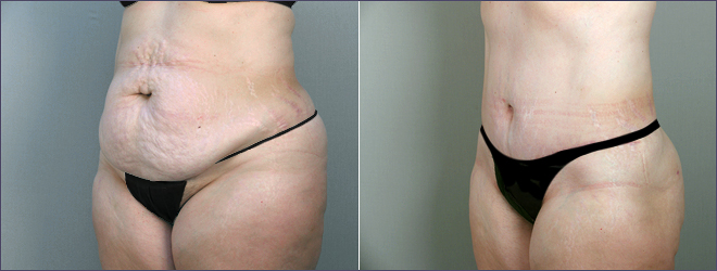 abdominoplasty new jersey