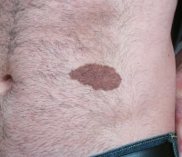 Skin Cancer New Jersey