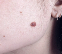 Skin Cancer New Jersey