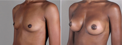 Breast Augmentation Patient