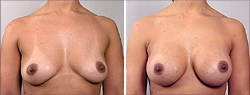 Breast Implants Before and After Images