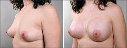Breast Implants Before and After Images