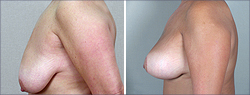Breast Lift Before and After Images