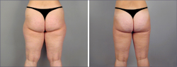 Liposuction Before and After Images