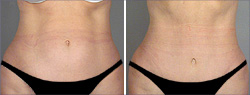 Tummy Tuck Before and After Images