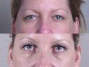 newjerseyeyelidsurgery_before_after.jpg