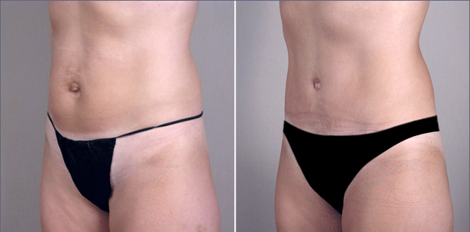 New Jersey Tummy Tuck Image New Jersey Tummy Tuck Image
