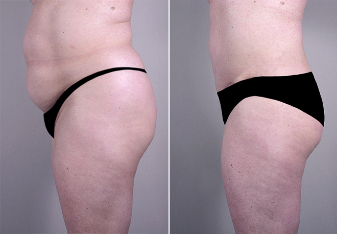 0_new_jersey_lipoabdominoplasty.jpg