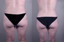 lipoabdominoplasty_new_jersey_beforeafter_back.jpg
