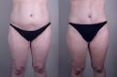 lipoabdominoplasty_new_jersey_beforeafter_front.jpg