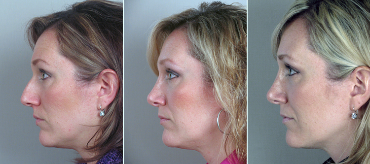 rhinoplasty-11b-triple.jpg