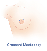 breast-lift-diagram-crescent-mastopexy