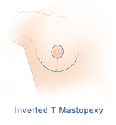 breast-lift-diagram-inverted-t-mastopexy