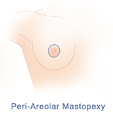 breast-lift-diagram-peri-areolar-mastopexy