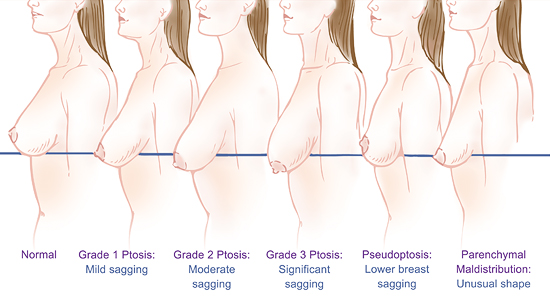 new jersey breast lift diagram-ptosis