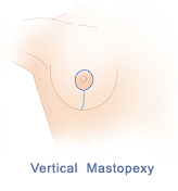 breast-lift-diagram-vertical-mastopexy