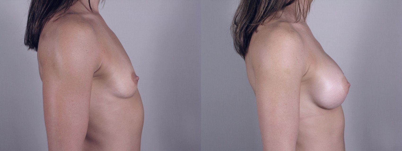 New Jersey Breast Augmentation Image