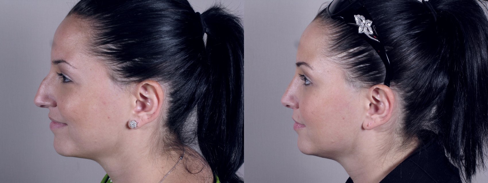 rhinoplasty-after-before-side.jpg