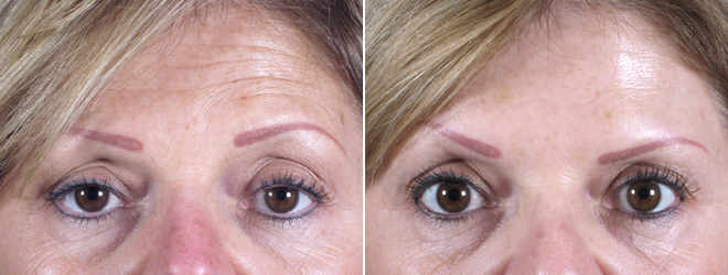 Botox® Cosmetic Patient 3