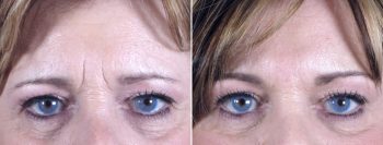 Botox® Cosmetic with Juvederm Patient 4