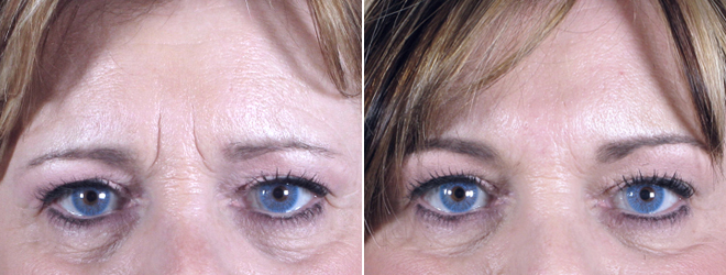 Botox® Cosmetic with Juvederm Patient 4