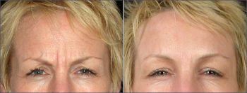 Botox® Cosmetic Patient 1