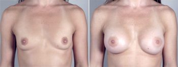 Breast Enlargement (Augmentation) Patient 15