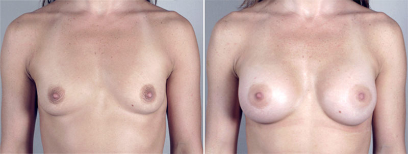 Breast Enlargement (Augmentation) Patient 15