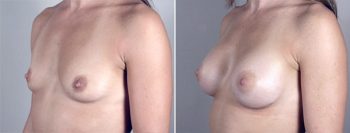 Breast Enlargement (Augmentation) Patient 15