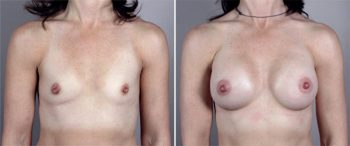 Breast Enlargement (Augmentation) Patient 20
