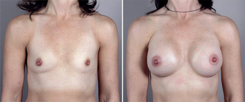 Breast Enlargement (Augmentation) Patient 20