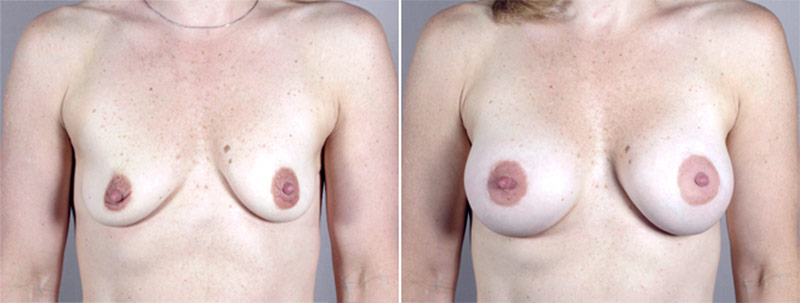 Breast Enlargement (Augmentation) Patient 16