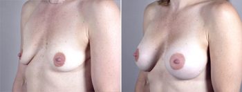 Breast Enlargement (Augmentation) Patient 16