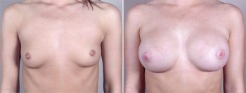 Breast Enlargement (Augmentation) Patient 19