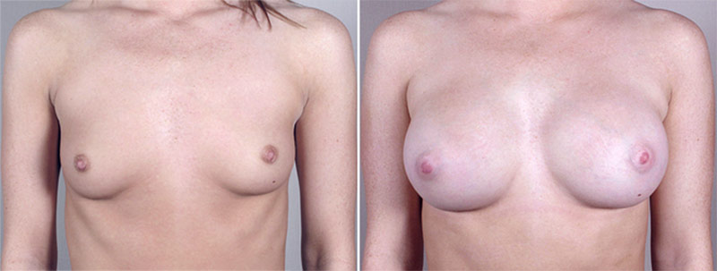 Breast Enlargement (Augmentation) Patient 19