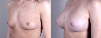 Breast Enlargement (Augmentation) Patient 19