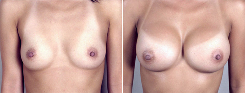 Breast Enlargement (Augmentation) Patient 26