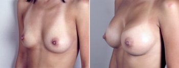 Breast Enlargement (Augmentation) Patient 26