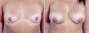 Breast Enlargement (Augmentation) Patient 28