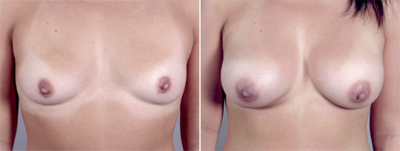 Breast Enlargement (Augmentation) Patient 28