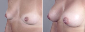 Breast Enlargement (Augmentation) Patient 28