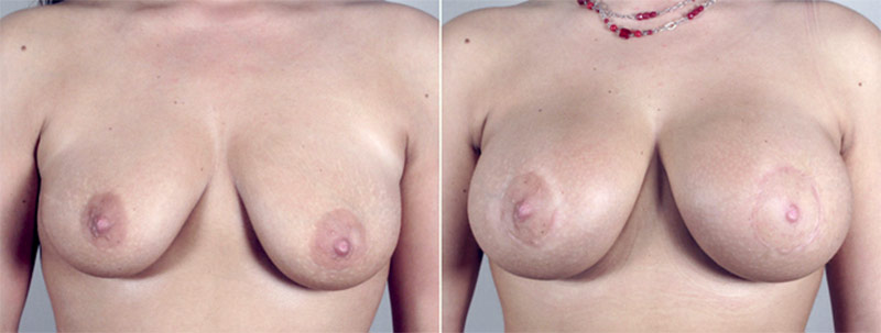 Breast Enlargement (Augmentation) Patient 29