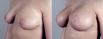 Breast Enlargement (Augmentation) Patient 29