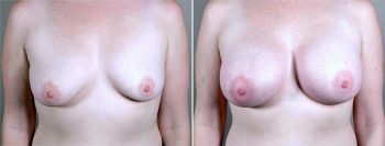 Breast Enlargement (Augmentation) Patient 30